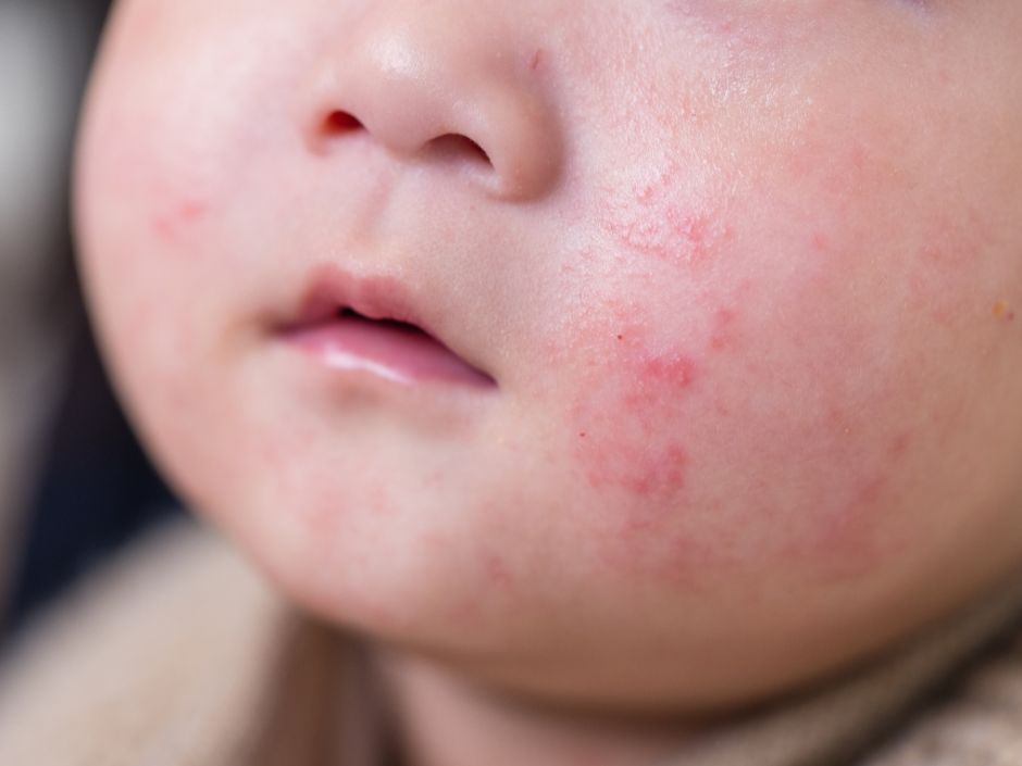 Baby Eczema: Causes, Symptoms & How to Treat It Safely