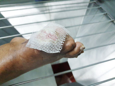 Why Diabetic Skin Problems Should Never Be Ignored (And How to Treat Them Early)