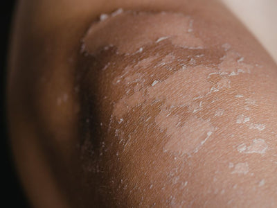 Why Diabetic Skin Becomes Dark, Itchy & Dry (And What You Can Do About It)