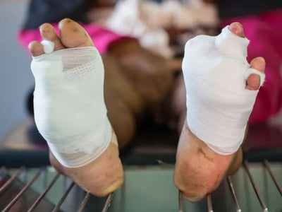 Slow Healing Wounds in Diabetes: What It Means & How to Prevent It