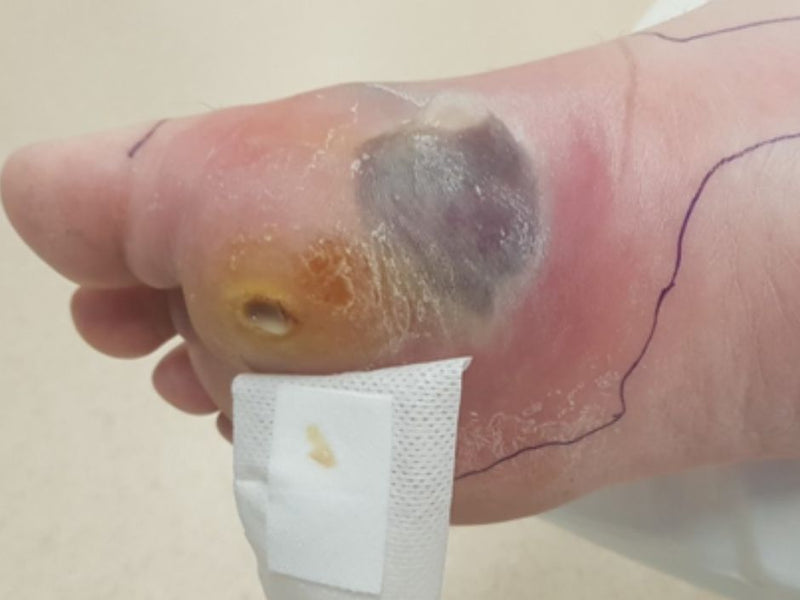 Stages of Diabetic Foot: Early Signs You Should Never Ignore